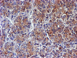 SMS / Spermine Synthase Antibody - IHC of paraffin-embedded Carcinoma of Human liver tissue using anti-SMS mouse monoclonal antibody.