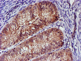 SMS / Spermine Synthase Antibody - IHC of paraffin-embedded Adenocarcinoma of Human endometrium tissue using anti-SMS mouse monoclonal antibody.