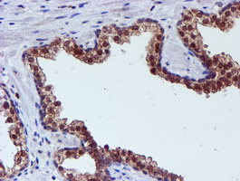 SMS / Spermine Synthase Antibody - IHC of paraffin-embedded Carcinoma of Human prostate tissue using anti-SMS mouse monoclonal antibody.
