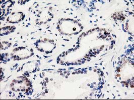 SMS / Spermine Synthase Antibody - IHC of paraffin-embedded Carcinoma of Human prostate tissue using anti-SMS mouse monoclonal antibody.