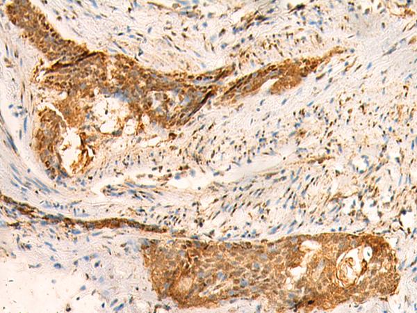 SMUG1 Antibody - Immunohistochemistry of paraffin-embedded Human esophagus cancer tissue  using SMUG1 Polyclonal Antibody at dilution of 1:50(×200)