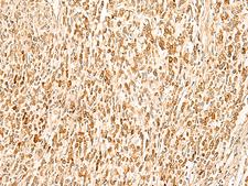 SMUG1 Antibody - Immunohistochemistry of paraffin-embedded Human gastric cancer tissue  using SMUG1 Polyclonal Antibody at dilution of 1:50(×200)