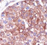 SMURF1 Antibody - Formalin-fixed and paraffin-embedded human cancer tissue reacted with the primary antibody, which was peroxidase-conjugated to the secondary antibody, followed by DAB staining. This data demonstrates the use of this antibody for immunohistochemistry; clinical relevance has not been evaluated. BC = breast carcinoma; HC = hepatocarcinoma.