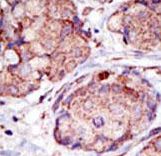 SMURF2 Antibody - Formalin-fixed and paraffin-embedded human cancer tissue reacted with the primary antibody, which was peroxidase-conjugated to the secondary antibody, followed by AEC staining. This data demonstrates the use of this antibody for immunohistochemistry; clinical relevance has not been evaluated. BC = breast carcinoma; HC = hepatocarcinoma.