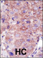 SMURF2 Antibody - Formalin-fixed and paraffin-embedded human cancer tissue reacted with the primary antibody, which was peroxidase-conjugated to the secondary antibody, followed by DAB staining. This data demonstrates the use of this antibody for immunohistochemistry; clinical relevance has not been evaluated. BC = breast carcinoma; HC = hepatocarcinoma.