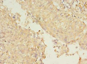 SMURF2 Antibody - Immunohistochemistry of paraffin-embedded human lung cancer tissue using antibody at 1:100 dilution.