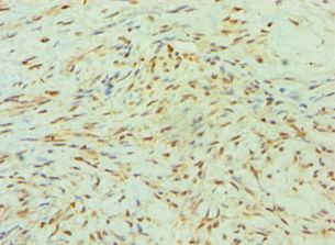 SMYD3 Antibody - Immunohistochemistry of paraffin-embedded human breast cancer using antibody at 1:100 dilution.