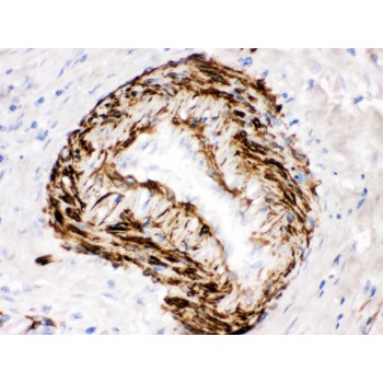 SMYD3 Antibody - SMYD3 was detected in paraffin-embedded sections of human intestinal cancer tissues using rabbit anti- SMYD3 Antigen Affinity purified polyclonal antibody at 1 ug/mL. The immunohistochemical section was developed using SABC method.