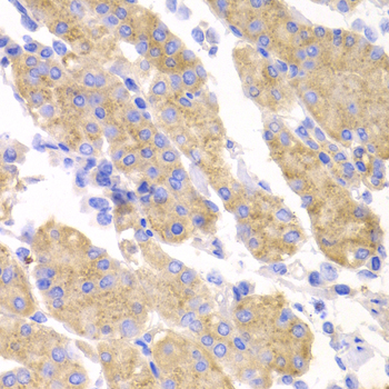 SMYD4 Antibody - Immunohistochemistry of paraffin-embedded human stomach cancer tissue.