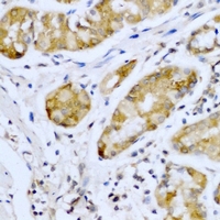 SMYD4 Antibody - Immunohistochemical analysis of SMYD4 staining in human stomach cancer formalin fixed paraffin embedded tissue section. The section was pre-treated using heat mediated antigen retrieval with sodium citrate buffer (pH 6.0). The section was then incubated with the antibody at room temperature and detected using an HRP conjugated compact polymer system. DAB was used as the chromogen. The section was then counterstained with hematoxylin and mounted with DPX.