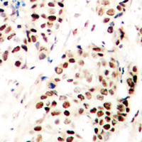 SNAI1 + SNAI2 Antibody - Immunohistochemical analysis of SNAI1/2 (pS246) staining in human breast cancer formalin fixed paraffin embedded tissue section. The section was pre-treated using heat mediated antigen retrieval with sodium citrate buffer (pH 6.0). The section was then incubated with the antibody at room temperature and detected using an HRP conjugated compact polymer system. DAB was used as the chromogen. The section was then counterstained with hematoxylin and mounted with DPX.