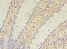 SNAI1 / SNAIL-1 Antibody - Immunohistochemistry of paraffin-embedded human colon cancer using antibody at dilution of 1:100.