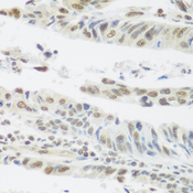 SNAI1 / SNAIL-1 Antibody - Immunohistochemistry of paraffin-embedded human colon carcinoma tissue.