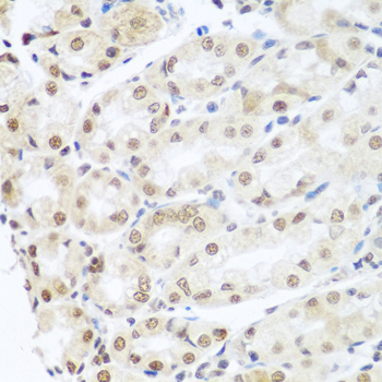 SNAI1 / SNAIL-1 Antibody - Immunohistochemistry of paraffin-embedded human gastric cancer tissue.