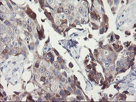 SNAI2 / SLUG Antibody - IHC of paraffin-embedded Adenocarcinoma of Human breast tissue using anti-SNAI2 mouse monoclonal antibody.