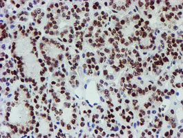 SNAI2 / SLUG Antibody - IHC of paraffin-embedded Carcinoma of Human thyroid tissue using anti-SNAI2 mouse monoclonal antibody.