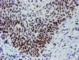 SNAI2 / SLUG Antibody - IHC of paraffin-embedded Carcinoma of Human bladder tissue using anti-SNAI2 mouse monoclonal antibody.