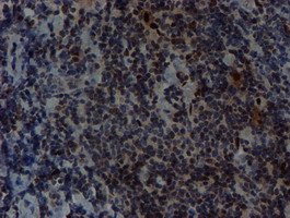 SNAI2 / SLUG Antibody - IHC of paraffin-embedded Human lymphoma tissue using anti-SNAI2 mouse monoclonal antibody.