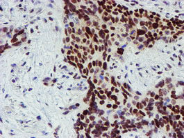 SNAI2 / SLUG Antibody - IHC of paraffin-embedded Carcinoma of Human lung tissue using anti-SNAI2 mouse monoclonal antibody.