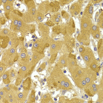 SNAI2 / SLUG Antibody - Immunohistochemistry of paraffin-embedded human liver injury using SNAI2 Antibodyat dilution of 1:100 (40x lens).