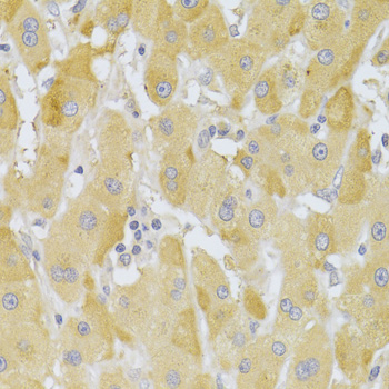SNAI2 / SLUG Antibody - Immunohistochemistry of paraffin-embedded human liver cancer using SNAI2 Antibodyat dilution of 1:100 (40x lens).