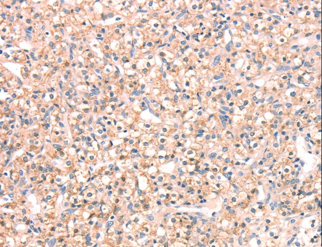 SNAP23 / SNAP-23 Antibody - Immunohistochemistry of paraffin-embedded Human prostate cancer using SNAP23 Polyclonal Antibody at dilution of 1:25.