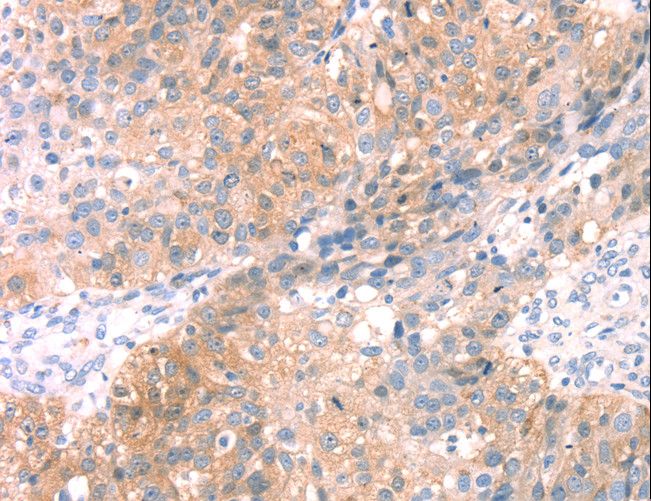 SNAP23 / SNAP-23 Antibody - Immunohistochemistry of paraffin-embedded Human breast cancer using SNAP23 Polyclonal Antibody at dilution of 1:25.