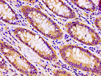 SNAP23 / SNAP-23 Antibody - Immunohistochemistry image at a dilution of 1:100 and staining in paraffin-embedded human colon cancer performed on a Leica BondTM system. After dewaxing and hydration, antigen retrieval was mediated by high pressure in a citrate buffer (pH 6.0) . Section was blocked with 10% normal goat serum 30min at RT. Then primary antibody (1% BSA) was incubated at 4 °C overnight. The primary is detected by a biotinylated secondary antibody and visualized using an HRP conjugated SP system.