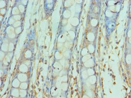 SNAP25 Antibody - Immunohistochemistry of paraffin-embedded human rectal cancer using antibody at 1:100 dilution.