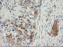 SNAP25 Antibody - IHC of paraffin-embedded Adenocarcinoma of Human breast tissue using anti-SNAP25 mouse monoclonal antibody.