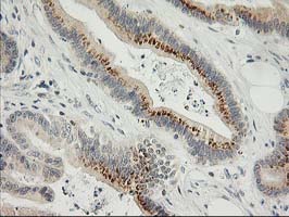 SNAP25 Antibody - IHC of paraffin-embedded Adenocarcinoma of Human colon tissue using anti-SNAP25 mouse monoclonal antibody.