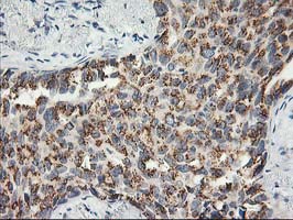 SNAP25 Antibody - IHC of paraffin-embedded Carcinoma of Human lung tissue using anti-SNAP25 mouse monoclonal antibody.