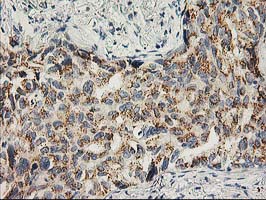 SNAP25 Antibody - IHC of paraffin-embedded Carcinoma of Human lung tissue using anti-SNAP25 mouse monoclonal antibody.