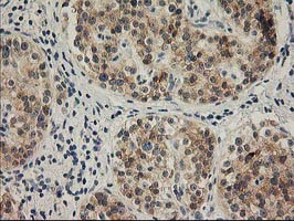 SNAP25 Antibody - IHC of paraffin-embedded Carcinoma of Human pancreas tissue using anti-SNAP25 mouse monoclonal antibody.