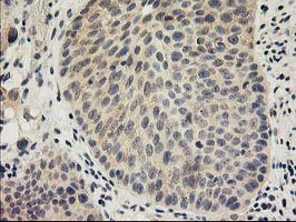 SNAP25 Antibody - IHC of paraffin-embedded Carcinoma of Human bladder tissue using anti-SNAP25 mouse monoclonal antibody.