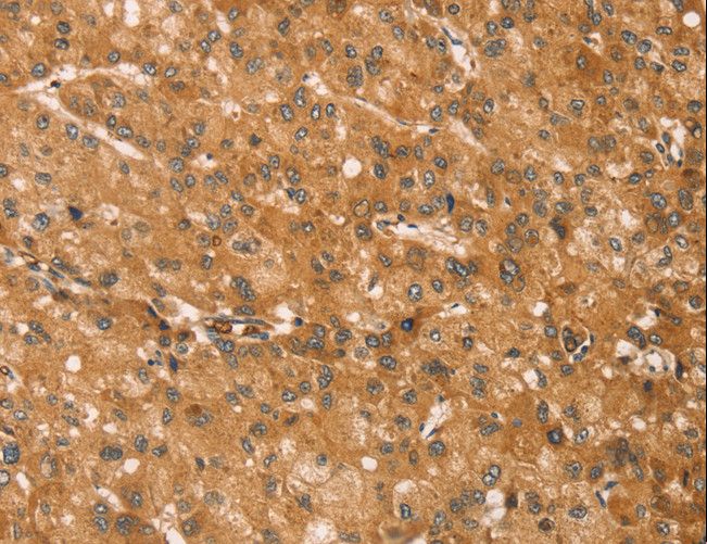 SNAP29 Antibody - Immunohistochemistry of paraffin-embedded Human liver cancer using SNAP29 Polyclonal Antibody at dilution of 1:45.