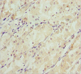 SNAP29 Antibody - Immunohistochemistry of paraffin-embedded human gastric cancer at dilution 1:100