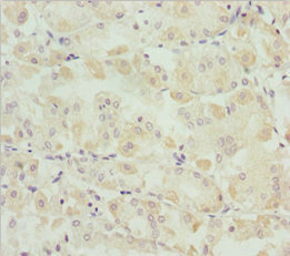 SNAP29 Antibody - Immunohistochemistry of paraffin-embedded human gastric cancer at dilution 1:100