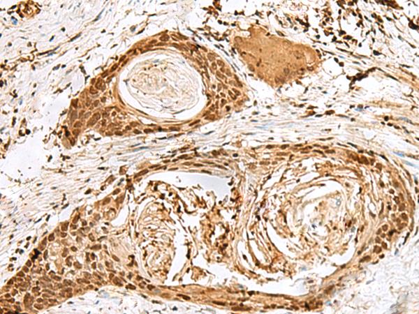 SNAPC1 Antibody - Immunohistochemistry of paraffin-embedded Human esophagus cancer tissue  using SNAPC1 Polyclonal Antibody at dilution of 1:40(×200)