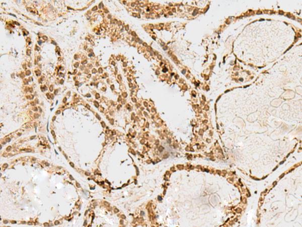 SNAPC1 Antibody - Immunohistochemistry of paraffin-embedded Human thyroid cancer tissue  using SNAPC1 Polyclonal Antibody at dilution of 1:60(×200)
