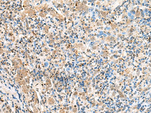 SNAPC1 Antibody - Immunohistochemistry of paraffin-embedded Human cervical cancer tissue  using SNAPC1 Polyclonal Antibody at dilution of 1:60(×200)