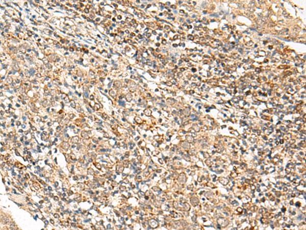 SNAPC5 Antibody - Immunohistochemistry of paraffin-embedded Human cervical cancer tissue  using SNAPC5 Polyclonal Antibody at dilution of 1:25(×200)