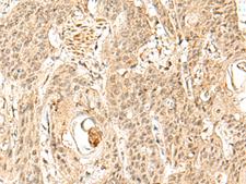 SNAPC5 Antibody - Immunohistochemistry of paraffin-embedded Human esophagus cancer tissue  using SNAPC5 Polyclonal Antibody at dilution of 1:30(×200)