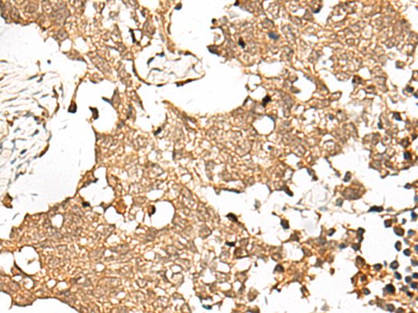 SNAPC5 Antibody - Immunohistochemistry of paraffin-embedded Human lung cancer tissue  using SNAPC5 Polyclonal Antibody at dilution of 1:30(×200)