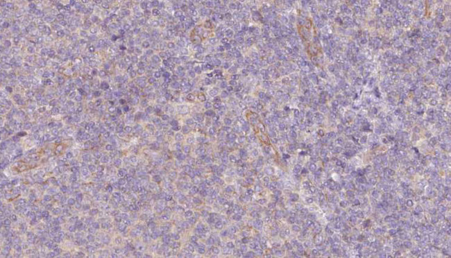 SNAPIN Antibody - 1:100 staining human lymph carcinoma tissue by IHC-P. The sample was formaldehyde fixed and a heat mediated antigen retrieval step in citrate buffer was performed. The sample was then blocked and incubated with the antibody for 1.5 hours at 22°C. An HRP conjugated goat anti-rabbit antibody was used as the secondary.