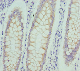 SNARK / NUAK2 Antibody - Immunohistochemistry of paraffin-embedded human colon cancer at dilution 1:100