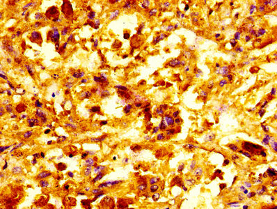 SNCA / Alpha-Synuclein Antibody - IHC image of SNCA Antibody diluted at 1:100 and staining in paraffin-embedded human melanoma performed on a Leica BondTM system. After dewaxing and hydration, antigen retrieval was mediated by high pressure in a citrate buffer (pH 6.0). Section was blocked with 10% normal goat serum 30min at RT. Then primary antibody (1% BSA) was incubated at 4°C overnight. The primary is detected by a biotinylated secondary antibody and visualized using an HRP conjugated SP system.