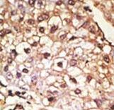 SNCA / Alpha-Synuclein Antibody - Formalin-fixed and paraffin-embedded human cancer tissue reacted with the primary antibody, which was peroxidase-conjugated to the secondary antibody, followed by AEC staining. This data demonstrates the use of this antibody for immunohistochemistry; clinical relevance has not been evaluated. BC = breast carcinoma; HC = hepatocarcinoma.