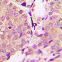 SNCA / Alpha-Synuclein Antibody - Immunohistochemical analysis of Alpha-synuclein (pY133) staining in human prostate cancer formalin fixed paraffin embedded tissue section. The section was pre-treated using heat mediated antigen retrieval with sodium citrate buffer (pH 6.0). The section was then incubated with the antibody at room temperature and detected using an HRP conjugated compact polymer system. DAB was used as the chromogen. The section was then counterstained with hematoxylin and mounted with DPX.