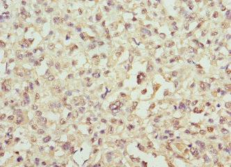 SNCA / Alpha-Synuclein Antibody - Immunohistochemistry of paraffin-embedded human melanoma using SNCA Antibody at dilution of 1:100